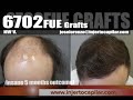 6702FUE Grafts. NW V. 3 step strategy. 2nd surgery, 5 months outcome. Injertocapilar.com. 2580/2020