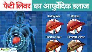 Fatty Liver Diseases: फैटी लिवर का अचूक आर्युर्वेदिक देसी इलाज जानिए | Ayurvedic Treatment