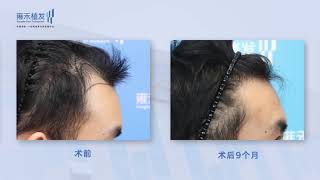 珠海髮際線植髮種植fue無痕植髮技術效果展示Yonghe hair transplant