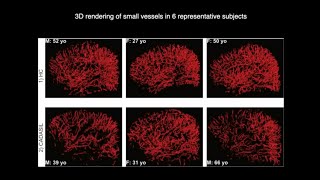 Small vessel density changes in CADASIL - Zidong Yang ISMRM 2024