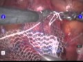 Robotic Supracervical Hysterectomy & Cervicosacropexy