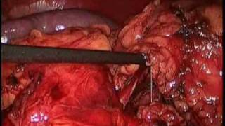 Part 1 - Left Laparoscopic Partial Nephrectomy