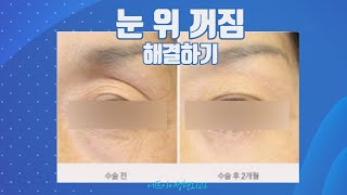 꺼진 눈 위 때문에 나이 들어보이는 얼굴이 고민이신가요?! │FI PLASTIC SURGERY CLINIC 에프아이 성형외과