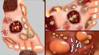 ASMR Treatment of Worm & Maggots Removal Infected Feet | Asmr Animation
