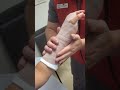 fiberglass wrist splint volar splint how to make...