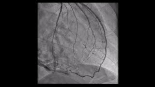 Constrictive Pericarditis