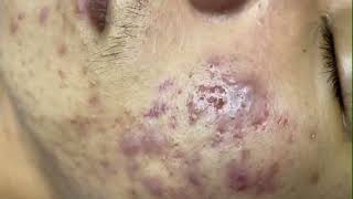 Infected Pimple Popping | Acne Zit Blackheads Removal | Inflamed Boil Cyst Pop Extraction on boy