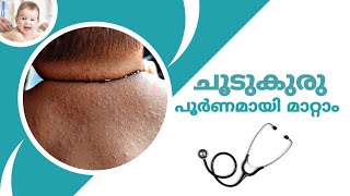 ചൂടുകുരു മാറാൻ ഇതിനേക്കാൾ നല്ല മരുന്നില്ല | Home Remedies for Choodu kuru | choodu kuru maaran