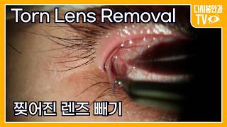 Removing a Torn Lens from Your Eye.