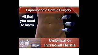 Laparascopic Incisional or Umbilical Hernia Surgery. Best Hospital In Ahmedabad, Gujarat, India
