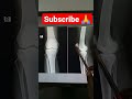 digital x ray knee joint normal shots