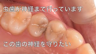 【4K】若くて元気な歯の神経が深い虫歯に冒された、抜きますか？