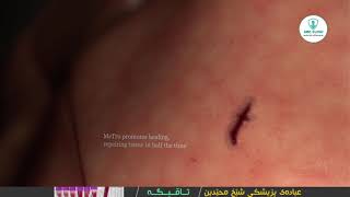 تەکنیکێکی نوێ بۆ سارێژ کردنی برین لە ماوەی ٦٠ چرکەدا