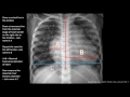 how to measure cardiomegaly in cxr