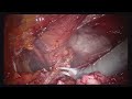 robotic preperitoneal incisional hernia