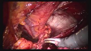 Robotic Preperitoneal Incisional Hernia