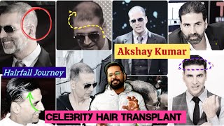 Akshay Kumar Hair Fall \u0026 Hair Transplant Story | Bollywood Celebrity Hair Transplant