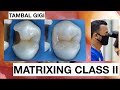 Step by Step Matrixing Class II Premolar | General Dentist Griya RR