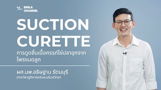 การดูดชิ้นเนื้อครรภ์ไข่ปลาอุกจากโพรงมดลูก (Suction and curette)