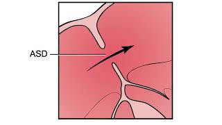 Preparing for the Cath Lab PFO ASD Closure | Heart Care Video Series