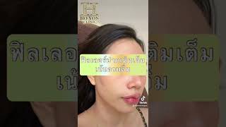 การยกมุมปากด้วยฟิลเลอร์กี่วันหาย #ยกมุมปาก #ฟิลเลอร์hoyonclinic #สงกรานต์ไปไหน #ทำสวย