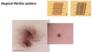 Pigmentation of the Sole - Dr. Michael Marchetti