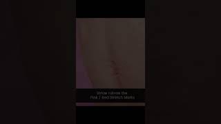Types of Stretch Marks | #shorts