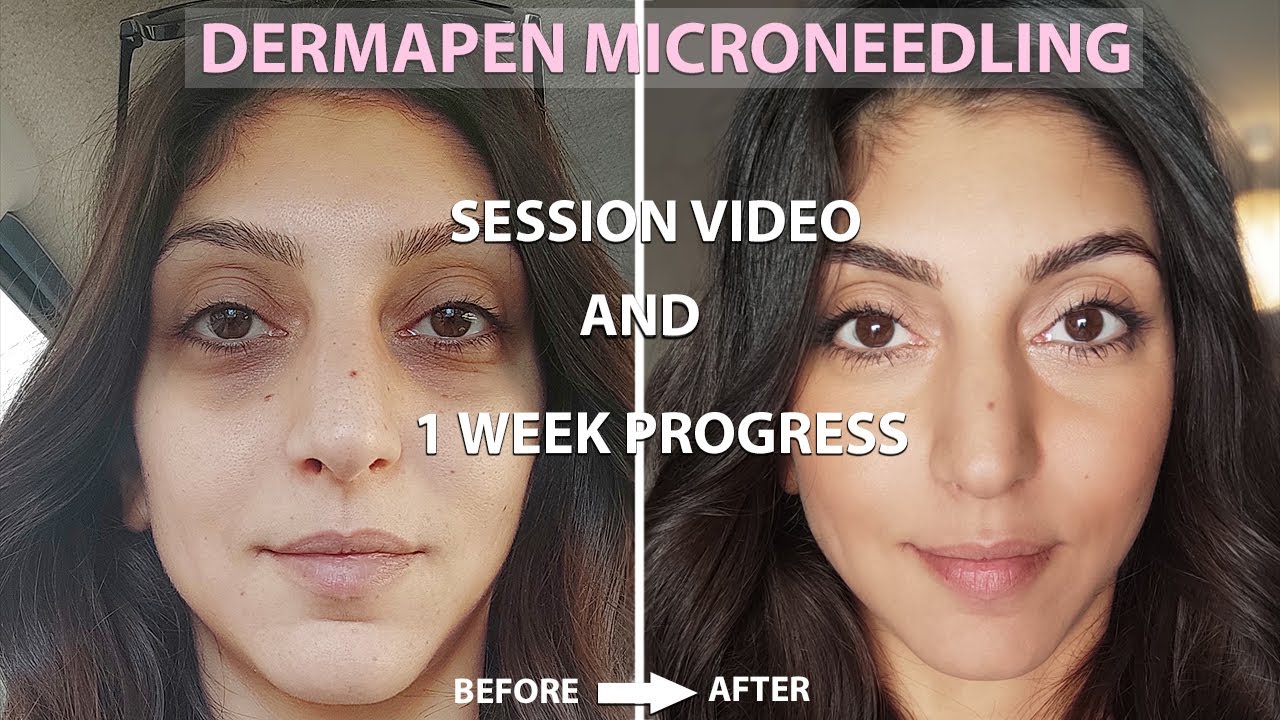 Dermapen Microneedling Before And After | Process + 1 Week Amazing ...