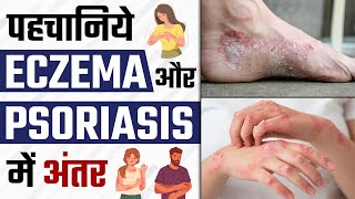 Eczema और Psoriasis में क्या अंतर हैं? | Symptoms \u0026 Causes of Eczema | How to Treat Eczema