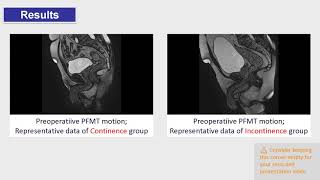 #24 Bladder elevation in pelvic floor muscle training evaluated by cine MRI (magnetic resonance ...