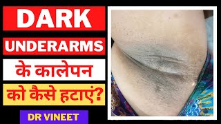Dark Underarms Causes & Treatment |Underarms के कालेपन के कारण और ईलाज| Dr Vineet |Dr Rekha |Bikaner