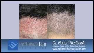 Difference between FUE vs  FUT Hair Transplantation