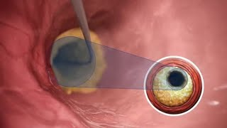 Debulking calcium with Hawkone™ directional atherectomy