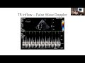 Multimodality Imaging: Constrictive Pericarditis