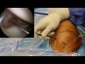 clear trac complete cannula shoulder arthroscopy access