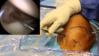 CLEAR-TRAC COMPLETE CANNULA Shoulder Arthroscopy Access