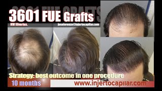 3601FUE Grafts. NW III vertex. Best outcome in one procedure. Injertocapilar.com. 2743/2022