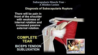 Subscapularis Muscle Tear A Hidden Lesion  - Everything You Need To Know - Dr. Nabil Ebraheim