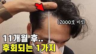 모발이식 후 11개월... 이건 꼭 알아야 합니다 (100% 솔직 후기)