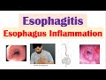 Esophagitis (Esophagus Inflammation): Causes, Risk Factors, Signs and Symptoms, Diagnosis, Treatment