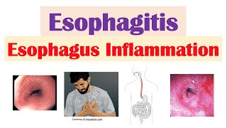 Esophagitis (Esophagus Inflammation): Causes, Risk Factors, Signs and Symptoms, Diagnosis, Treatment