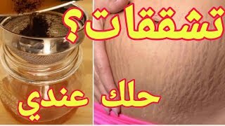 قولي وداعاً لتشققات الجلد, أترجعي جديدة ,STRETCH MARKS