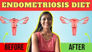 Endometriosis Diet | Foods to Eat and Avoid in Endometriosis