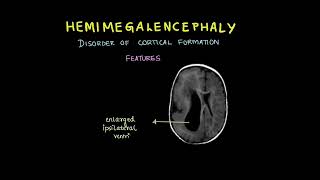 Hemimegalencephaly #Shorts #shorts