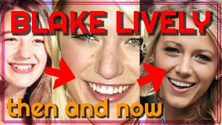 Blake Lively then and now: before & after rhinoplasty plastic surgery transformation teeth fixed