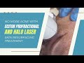 NO MORE ACNE WITH SCITON PROFRACTIONAL AND HALO LASER | Skin Resurfacing Treatment | Dr. Jason Emer