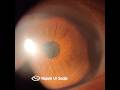 Dense Pupillary Membrane (Anterior Chamber Inflammation)  On Post-Cataract Surgery Day 1