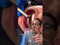 crown removal with dental laser at dental office in office to hands on dental training shorts