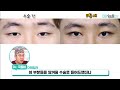 안검내반or속눈썹말림증 쌍수로 교정하기