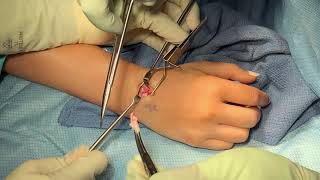 Wrist Ganglion Cyst Excision